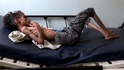 Skin and bones, 10-year-old Ghazi Saleh lies on a hospital bed in the southwestern Yemeni city of Taez barely breathing. AFP