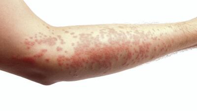 Psoriasis affects some 125 million people around the world. Getty