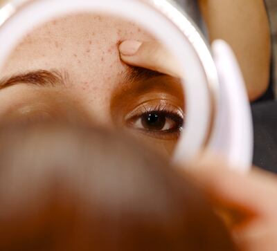 Breakouts are a normal part of adolescent life, but can be exacerbated by the wrong products. Getty Images