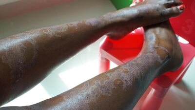 Germaletta Brown displays the burns she suffered to her legs after a black henna treatment. Delores Johnson / The National