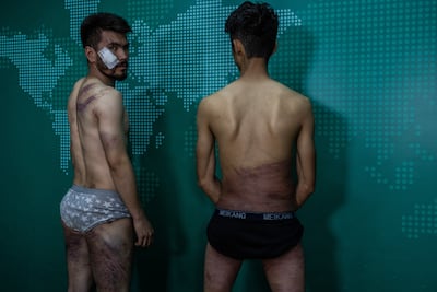 Nehmatullah Naqdi (left) and Taqi Daryabi show their scars..