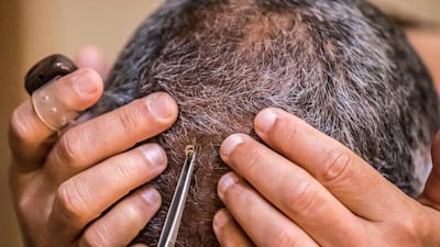 A bee is clasped at the scalp of a patient at the practice. Apitherapy is a traditional medicine in a number of countries, including Egypt. AFP