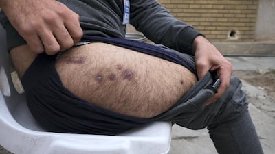 Ali Salam Jassem shows of the exit wounds for gunshots he was hit by in protests last year. Ameer Hazim for The National