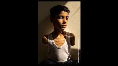 Samar Abu Elouf's image of Mahmoud Ajjour, nine, who was severely injured by Israeli bombs in 2024. Photo: Samar Abu Elouf for The New York Times