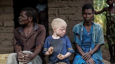 A file photo of an albino child sitting between his parents in the traditional authority area of Nkole, Machinga district. A Malawi court has banned witchdoctors from operating in the impoverished southern African country following a spate of albino killings linked to witchcraft, according to a court ruling seen on June 2, 2016. AFP / Gianluigi Guercia/AFP