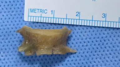 The 2cm fish bone was lodged in the Sharjah resident's lower airway. Photo: Aster DM Healthcare