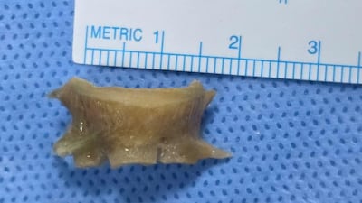 The 2cm fish bone was lodged in the Sharjah resident's lower airway. Photo: Aster DM Healthcare