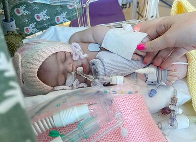 Amelia Turner was born with congenital diaphragmatic hernia, which meant her stomach and bowel moved into her chest. PA