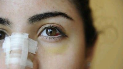 One teen says she decided to have it after seeing all her schoolfriends sporting plasters on their noses.