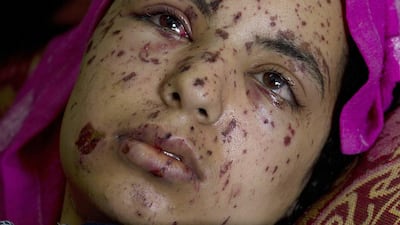 Rawia Abu Joma’a, 17, has not been informed that two Israeli rocket attacks had killed her four-year-old sister, Rahaf, as well as three cousins. Lying at the Shifa Hospital on July 22,2014, Rawia was wounded when two Israeli air strikes attacked her family's apartment on Sunday night. Heidi Levine for the National