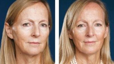 Before the treatment, left, and after, right.