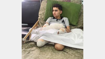Ahmad Al Ghalban lost both legs in an air strike that killed his twin brother Mohammed. Handout