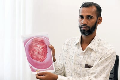 Mohammed Suman holds up a photo of the tumour he had removed from his abdomen. Satish Kumar for The National