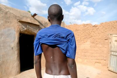 A boy shows scars on his back from what he says were beatings during his 13 days at a madrassa in Nigeria. REUTERS