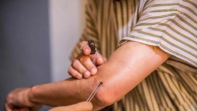 Bee sting venom is used at the practice to treat conditions such as rheumatic pain, nerve inflammation and arthritis. AFP