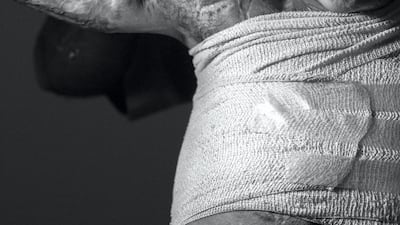 Seventeen-year-old Yousef used to spend hours riding his motorbike near his home in Baghdad once the sun had set and the day’s heat had eased. But on one such evening 18 months ago, a group of masked men attacked Yousef, stealing his motorbike and setting him on fire. He was left with severe burns over his upper body, neck and ears. Alessio Mamo / MSF