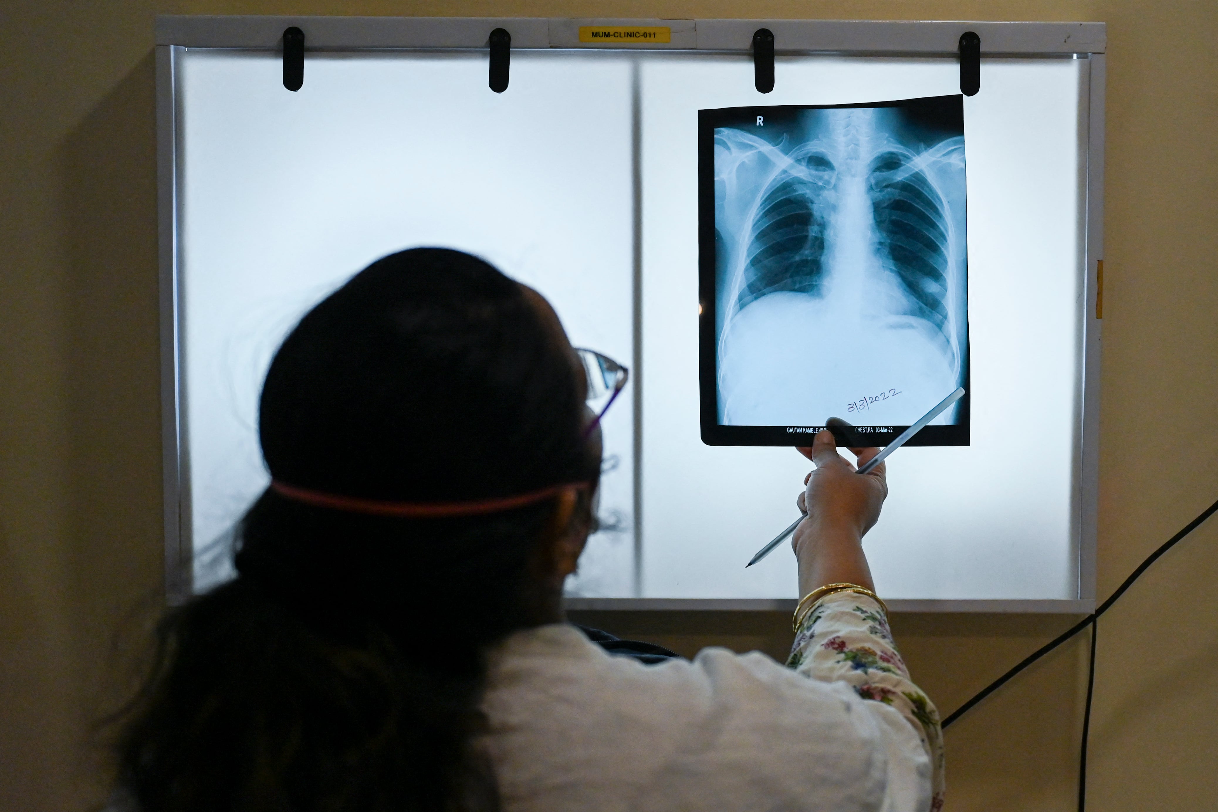 New tuberculosis blood test could reduce spread of killer infectious disease