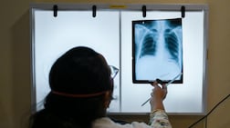 A doctor checks the chest X-rays of a patient with tuberculosis, a leading cause of death worldwide. EPA