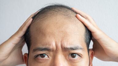 Pelage Pharmaceuticals have trialled a drug that aims to combat male-pattern baldness. Getty Images