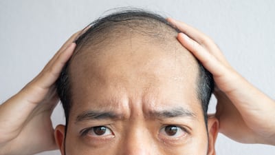 Pelage Pharmaceuticals have trialled a drug that aims to combat male-pattern baldness. Getty Images