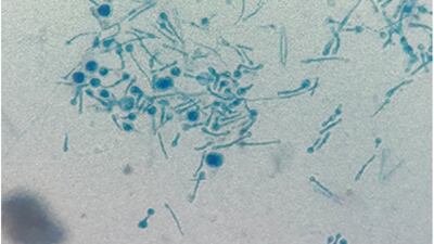 A mycologist from Kolkata city was infected by a fungal disease caused by the pathogen Chondrostereum purpureum. Photo: Medical Mycology Case Reports