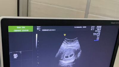 An ultrasound revealing two heartbeats.