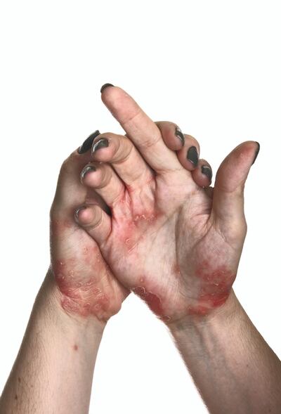 Tawam Hospital in the UAE aims to dispel the myth about the condition being contagious. Getty