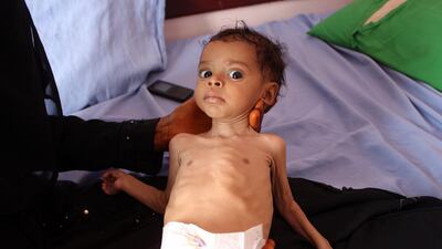A Yemeni toddler held by a woman at a clinic run by a humanitarian organisation in the port city of Hodeida, November 3, 2019. AFP