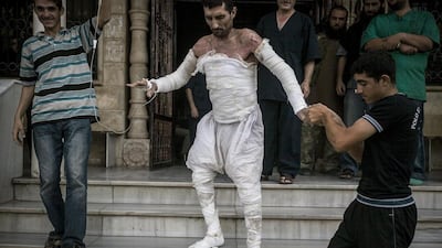 A Syrian man with more than half of his body burnt from an airstrike leaves a field hospital to return home in Idlib province, northern Syria. AP