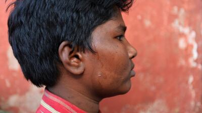 Pawan, 14, diagnosed with the early signs of leprosy with white patches on his face, poses for a photograph in the colony.