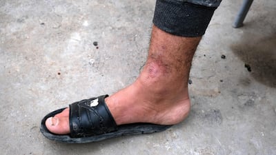 Ali Salam Jassem says is proud of the scars he has attained since he began participating in protests. Ameer Hazim for The National