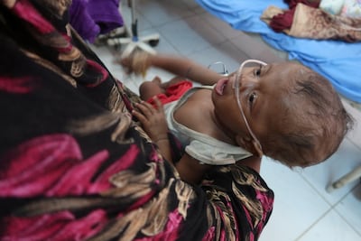 A child suffering from malnutrition at Port Sudan Paediatric Centre in Sudan on September 7, 2024. Reuters