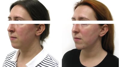 Before and after images of a patient who underwent cosmetic treatment, including jawline sculpting with a filler. Treatments like these may affect ID photos being recognised by facial scanners. All photos: The Soni Clinic