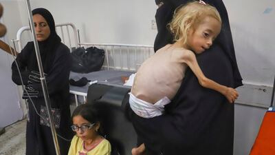 Islam Qudeih holds her severely malnourished two-year-old daughter, Shamm, at Nasser Hospital in Khan Younis, southern Gaza Strip. All photos: Mariam Dagga / AP