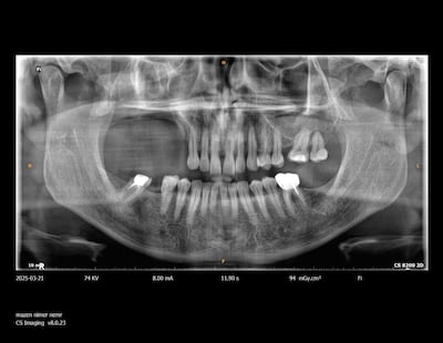Nimer Altaher was diagnosed with ameloblastoma, a rare but benign tumor of the upper jaw, in 2022. Photo: Medcare Dentofaces