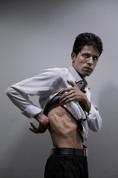 Mahmoud Al Ghabri, a journalist who was captured and tortured by Houthi rebels, shows his injuries in Marib, Yemen. AP