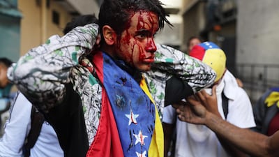 A wounded protester looks on as thousands take to the streets in Caracas. EPA