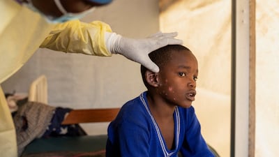 Mpox is a dangerous virus that can cause fever, swelling of the lymph nodes, pain and skin lesions. In some cases, it can be fatal, especially to children. Reuters