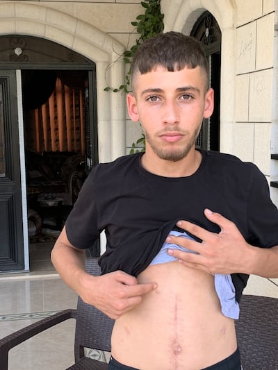 Ezzedeen Nidal Elwan, 19, points to the scar of a bullet's exit wound. He was shot in the back by an Israeli soldier as he fled a settler attack. Hamza Hendawi for The National