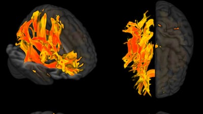The red shows the areas most affected by high blood pressurem while the yellow areas are also affected but to a lesser extent. Photo: Dr Lorenzo Carnevale