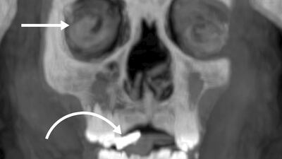 Scans of the child show gold rings inserted into his mouth cavity