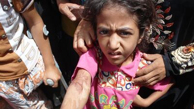 Zaineb, 11, who is in a camp for displaced Iraqis who fled Fallujah, shows the scars on her arm from being injured in a coalition air strike. Florian Neuhof for The National