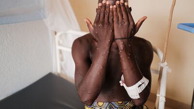 A man infected with Mpox shows his hands inside a ward at the Kamenge University Hospital's Mpox treatment centre, in Bujumbura, Burundi. AFP