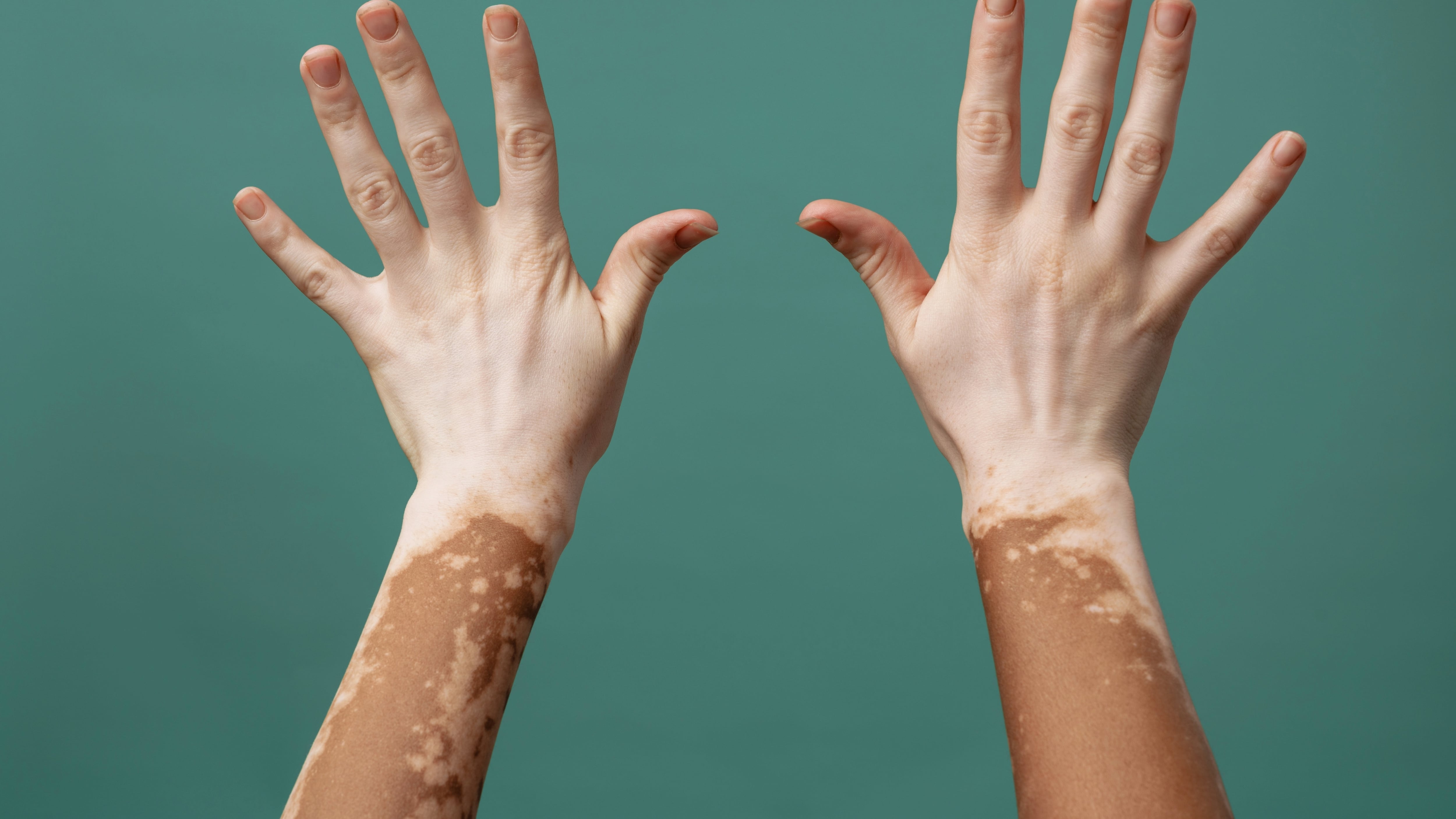 UAE approves new use of drug to treat vitiligo