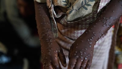 A patient with a severe form of the mpox is treated at the Kavumu Hospital, 30km north of Bukavu in the eastern Democratic Republic of Congo. AFP