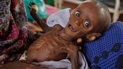 Mihag Gedi Farah, a seven-month-old child with a weight of 3.4kg, is held by his mother in a field hospital of the International Rescue Committee, IRC, in the town of Dadaab, Kenya, Tuesday, July 26, 2011. The U.N. will airlift emergency rations this week to parts of drought-ravaged Somalia that militants banned it from more than two years ago, in a crisis intervention to keep hungry refugees from dying along what an official calls the "roads of death." Tens of thousands already have trekked to neighboring Kenya and Ethiopia, hoping to get aid in refugee camps.(AP Photo/Schalk van Zuydam)