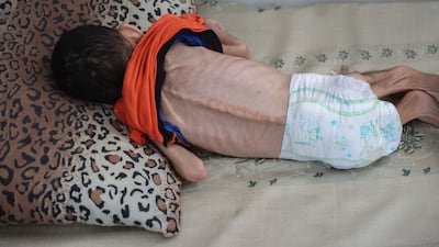 A Palestinian boy, 4, suffering from malnutrition in a hospital in central Gaza City. AFP