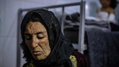 A woman is treated at a hospital in the Kurdish-controlled Syrian city of Hasakeh after a fire tore through a wedding party at Al Hol displacement camp. A Kurdish official said four children and a woman died. AFP