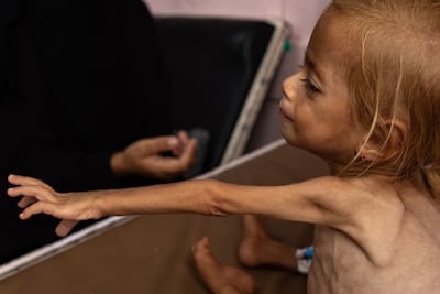 Two year-old Palestinian girl Sham Qudeih suffers from liver enlargement, severe malnutrition and severe abdominal swelling, with her weight having dropped to four kilogrammes. EPA