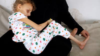 A woman holds her malnourished daughter undergoing treatment at a hospital in Sanaa, Yemen. Mohamed al-Sayaghi / Reuters.